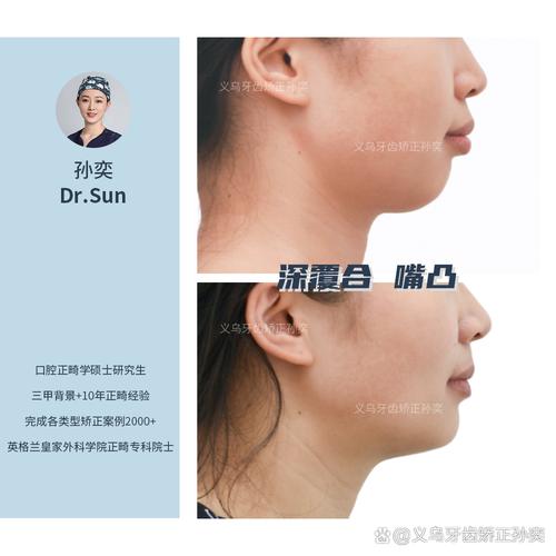 牙齿矫正凸嘴吗-图2 牙齿矫正凸嘴吗-图2