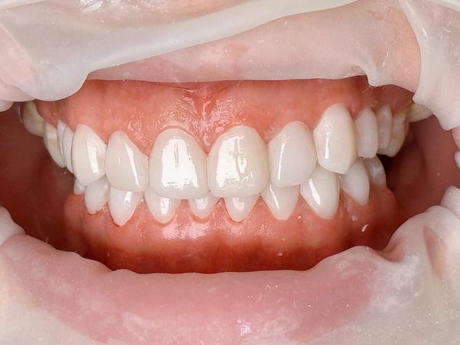 矫正牙齿用瓷贴面？效果和传统矫正有何区别？-图3