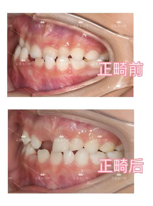 矫正牙齿分牙缝-图1 矫正牙齿分牙缝-图1