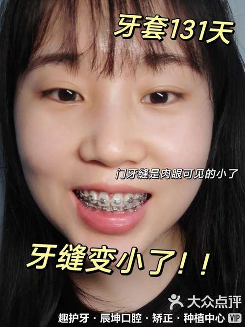 矫正牙齿分牙缝-图2 矫正牙齿分牙缝-图2