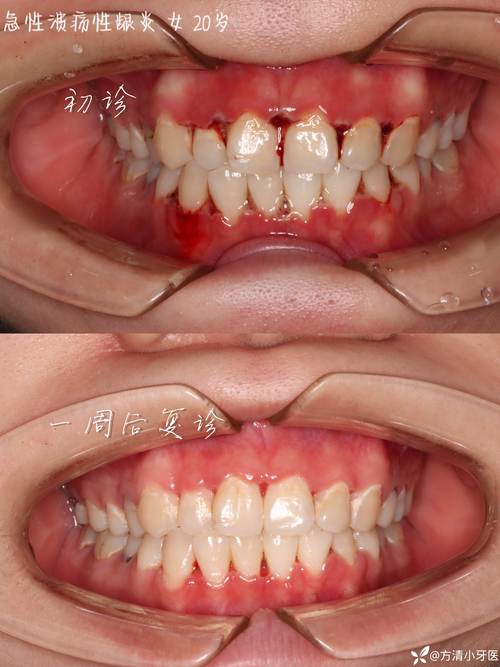矫正牙齿长溃疡怎么办？原因与护理技巧解析-图1