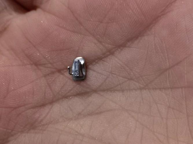 牙齿矫正后牙齿脱落？这是什么原因导致的？该如何处理？-图1