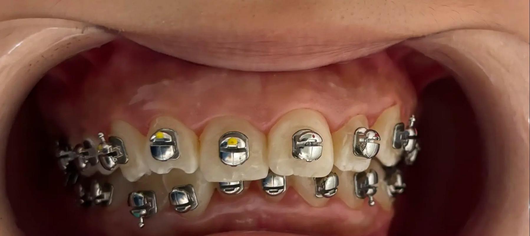 瑞典牙齿矫正有何独特优势?效果和费用如何?-图1 瑞典牙齿矫正有何独特优势?效果和费用如何?-图1