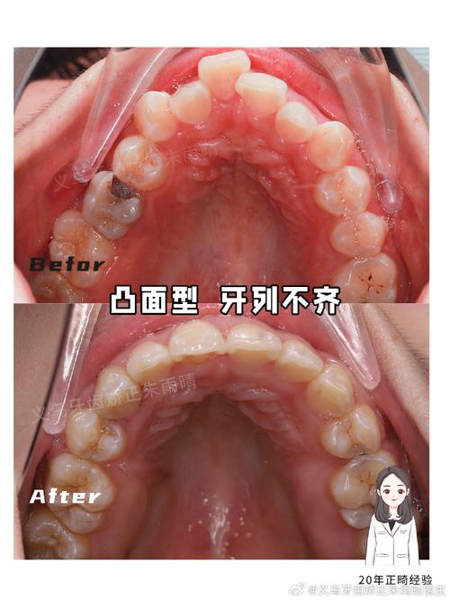矫正牙齿不配合？为什么？怎么办？原因和方法都在这？-图3