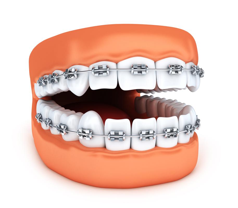 可以矫正牙齿的，有哪些可行方法？-图2