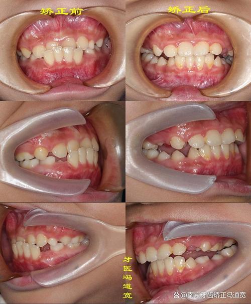 南京牙齿矫正后效果能维持多久？需注意哪些护理事项？-图1