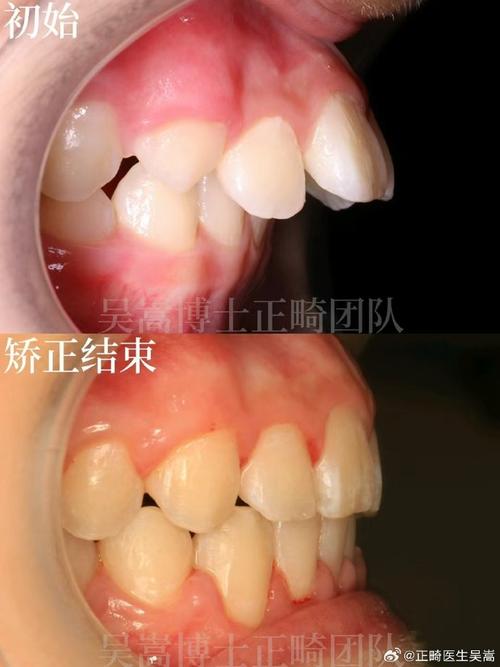 南京牙齿矫正后效果能维持多久？需注意哪些护理事项？-图2