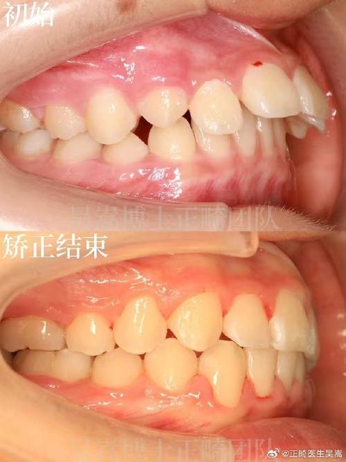 南京牙齿矫正后效果能维持多久？需注意哪些护理事项？-图3