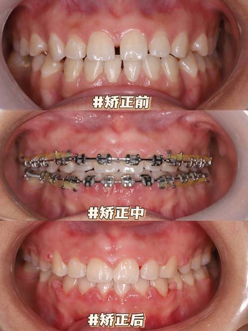 削骨 矫正牙齿-图3 削骨 矫正牙齿-图3