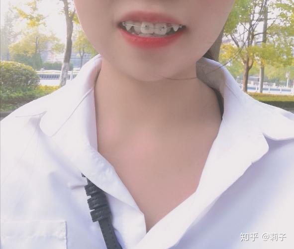 矫正牙齿拔虎牙，真的有必要这样做吗？-图2