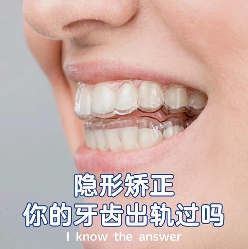 牙齿隐形矫正效果、时间、费用、适合人群,有哪些疑问?-图2 牙齿隐形矫正效果、时间、费用、适合人群,有哪些疑问?-图2