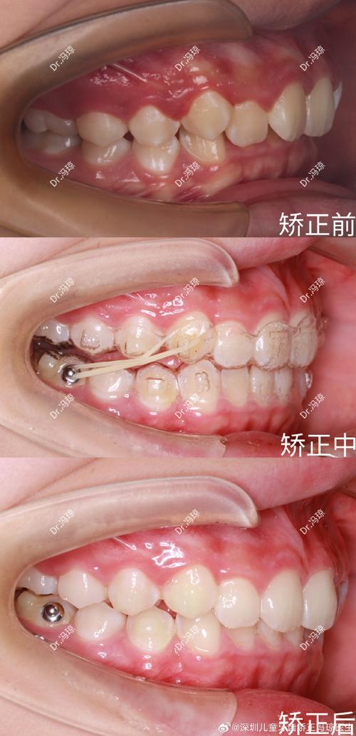 牙齿不严重矫正有必要吗？效果真的好吗？-图2