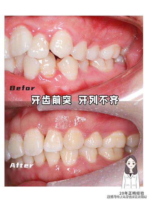 牙齿不严重矫正有必要吗？效果真的好吗？-图1