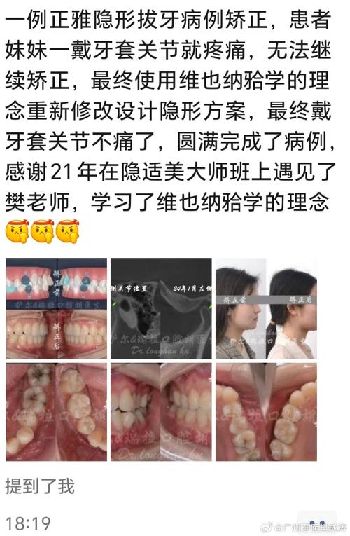 矫正牙齿对讲师的职业形象和授课效果会产生哪些影响？-图1