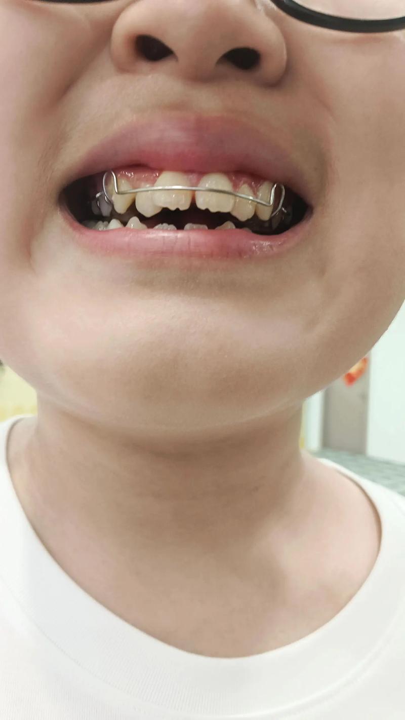 小孩牙齿矫正几岁开始最合适？有哪些常见方法？-图2