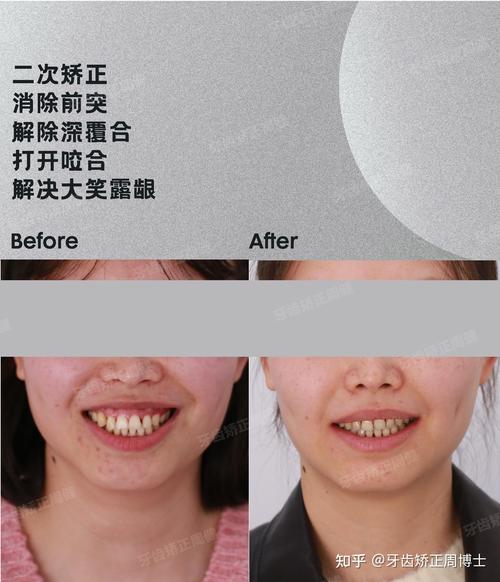 周博士牙齿矫正-图2