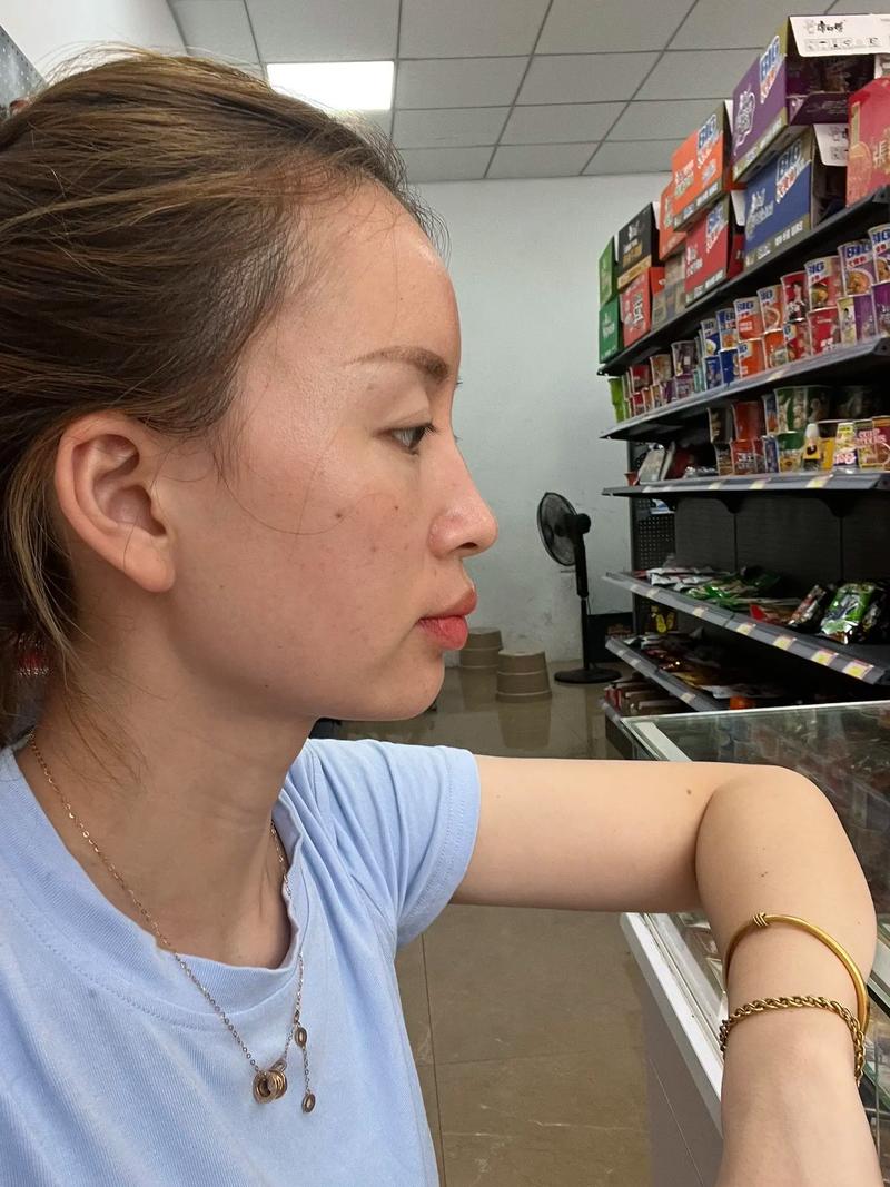 长脸矫正牙齿后-图1