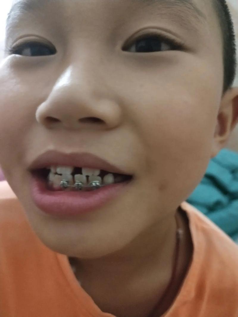 牙齿矫正 唱歌-图3