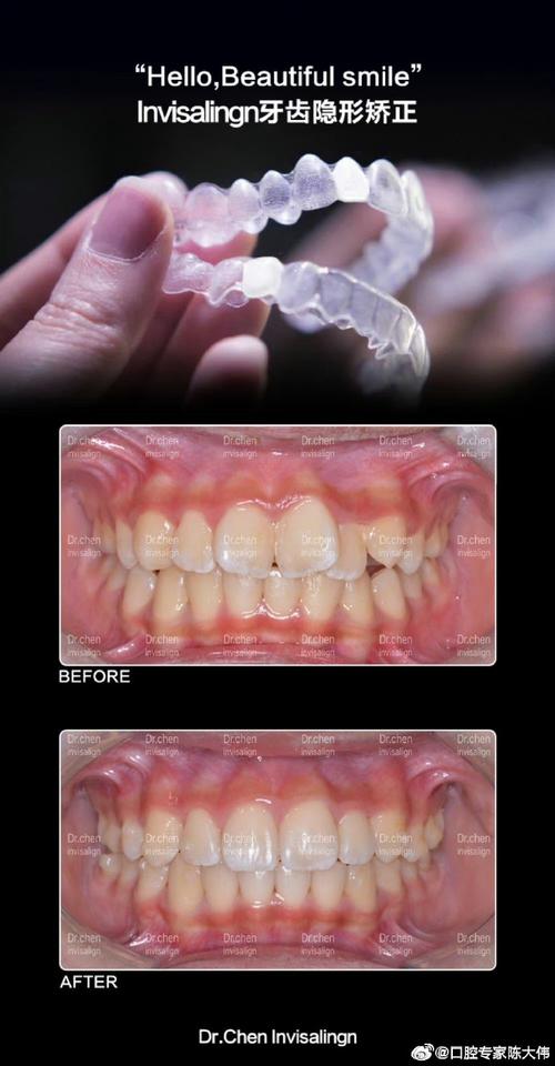 MRT牙齿矫正是什么?效果好吗?-图3 MRT牙齿矫正是什么?效果好吗?-图3