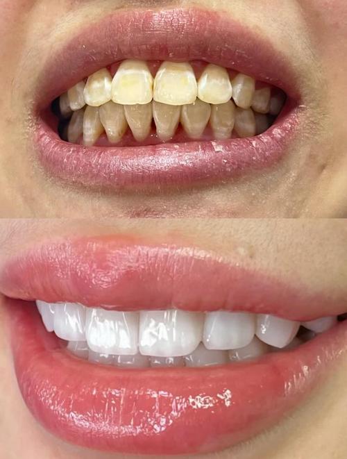 牙齿矫正 釉面-图1