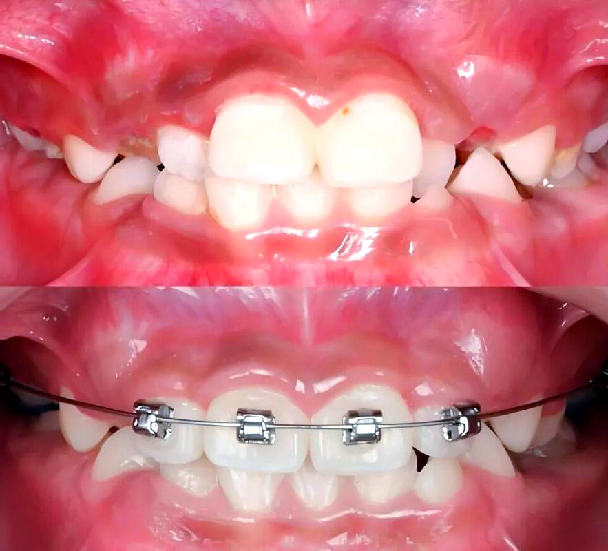 牙齿矫正会影响胎儿吗？-图2