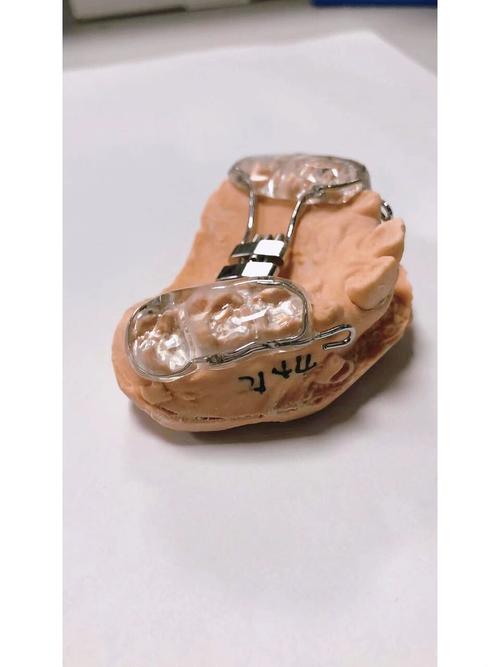 牙齿反合矫正器效果如何？适用哪些人群？-图1