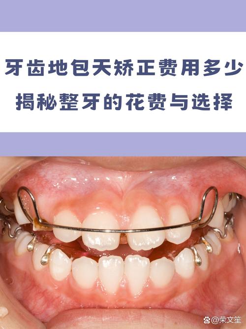 牙齿反合矫正器效果如何？适用哪些人群？-图3