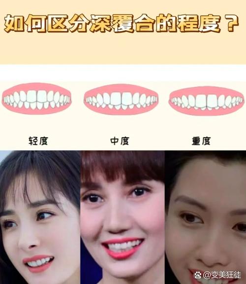 矫正深覆合牙齿有哪些有效方法？-图3