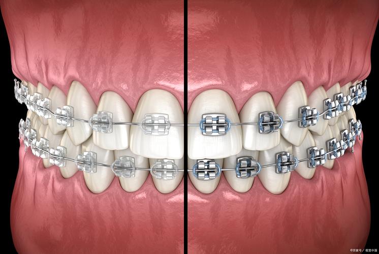 偏颌仅靠矫正牙齿能有效矫正吗？-图2