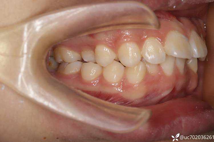 矫正拔牙的牙齿-图1