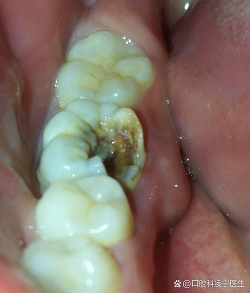 牙齿矫正牙根发痒，是牙齿移动的正常反应吗？-图1