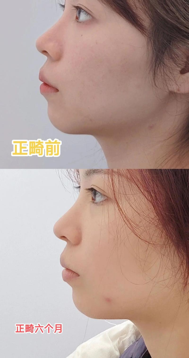 矫正牙齿的改变-图1