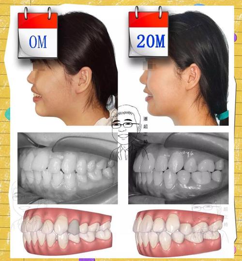 矫正牙齿的改变-图3