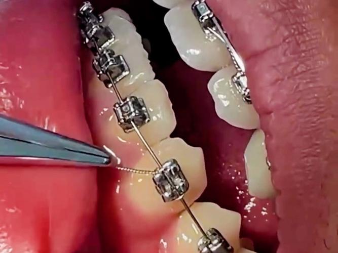 牙齿矫正后钢丝残留怎么办？不取会有影响吗？-图1