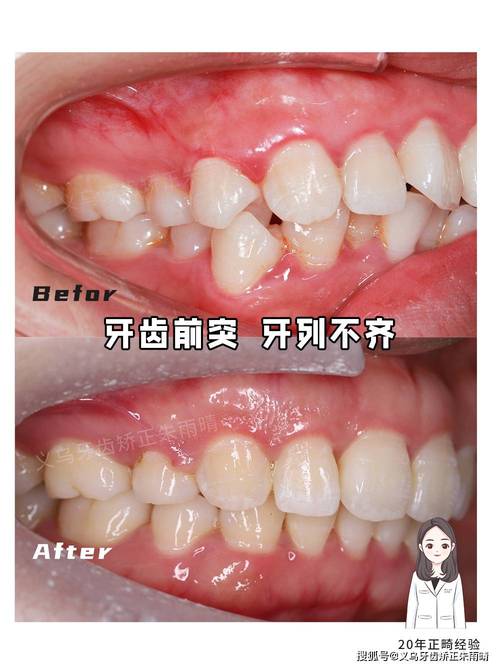 牙齿畸形不矫正，会引发哪些健康隐患？-图2