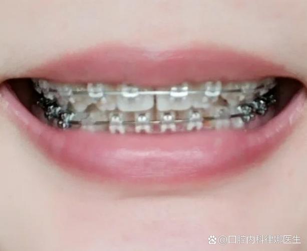 牙齿矫正粘托槽-图2