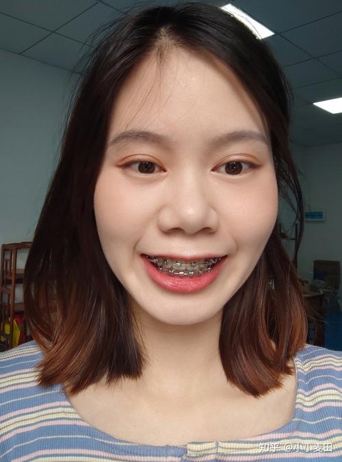 矫正牙齿 自锁-图3 矫正牙齿 自锁-图3