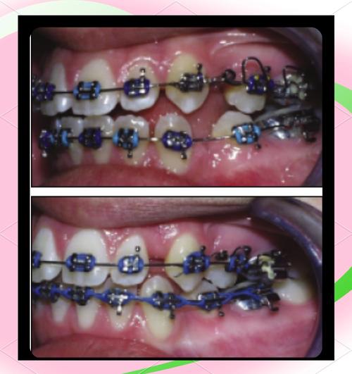 矫正牙齿上弹簧，究竟有何作用？-图1