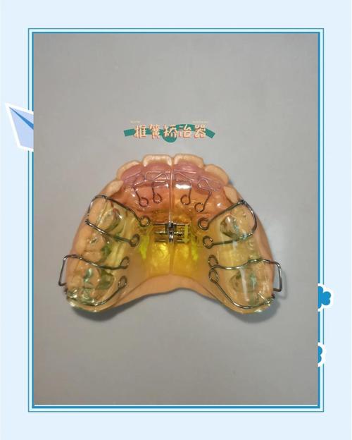 矫正牙齿上弹簧，究竟有何作用？-图2