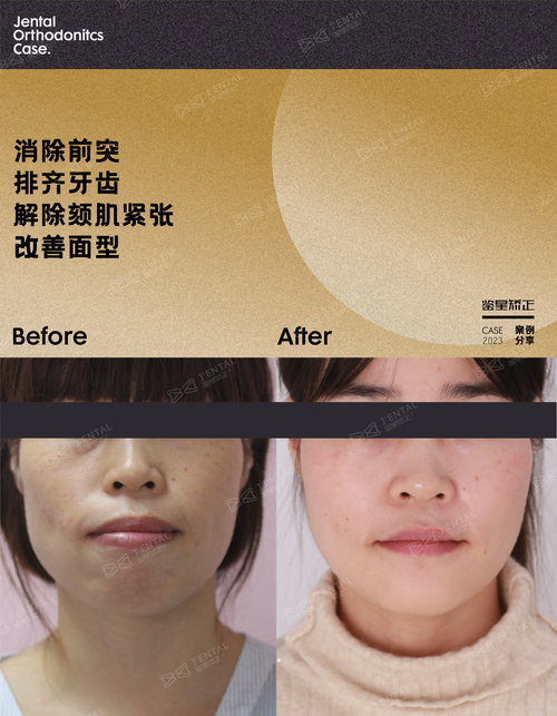 矫正牙齿往里收，对脸型和咬合功能有何影响？-图1