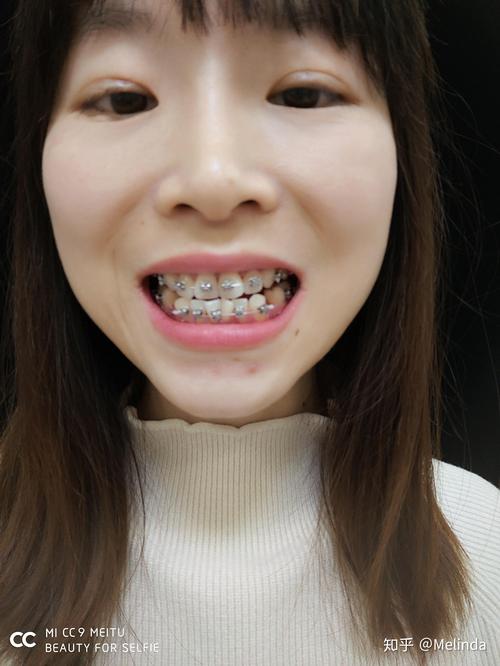 牙齿矫正期间怀孕，矫正会影响胎儿健康吗？-图3