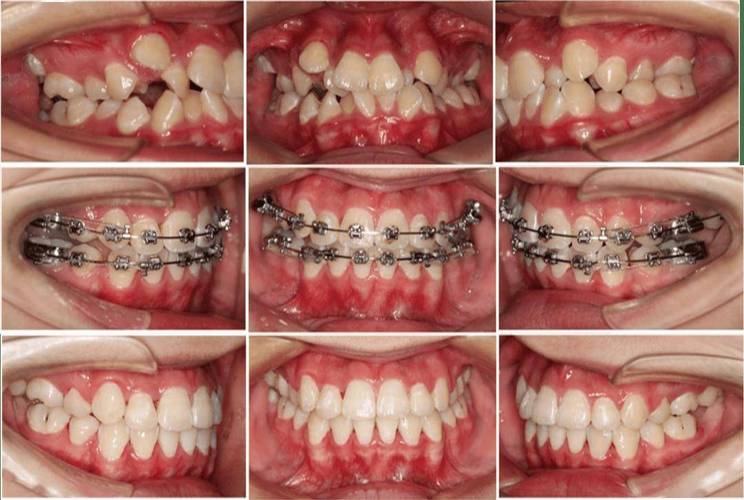 牙齿矫正过程是怎样的？关键步骤和注意事项有哪些？-图1