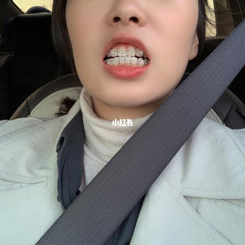 第三次矫正牙齿-图2