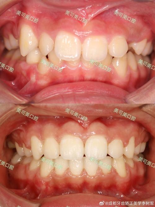 矫正后牙齿形状为何与预期有差异？该如何调整改善？-图2