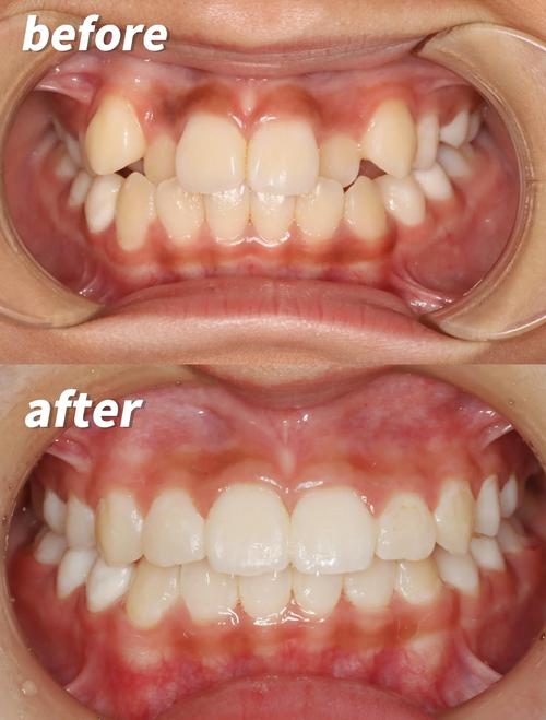 牙齿美白和矫正该先做哪个?-图1 牙齿美白和矫正该先做哪个?-图1