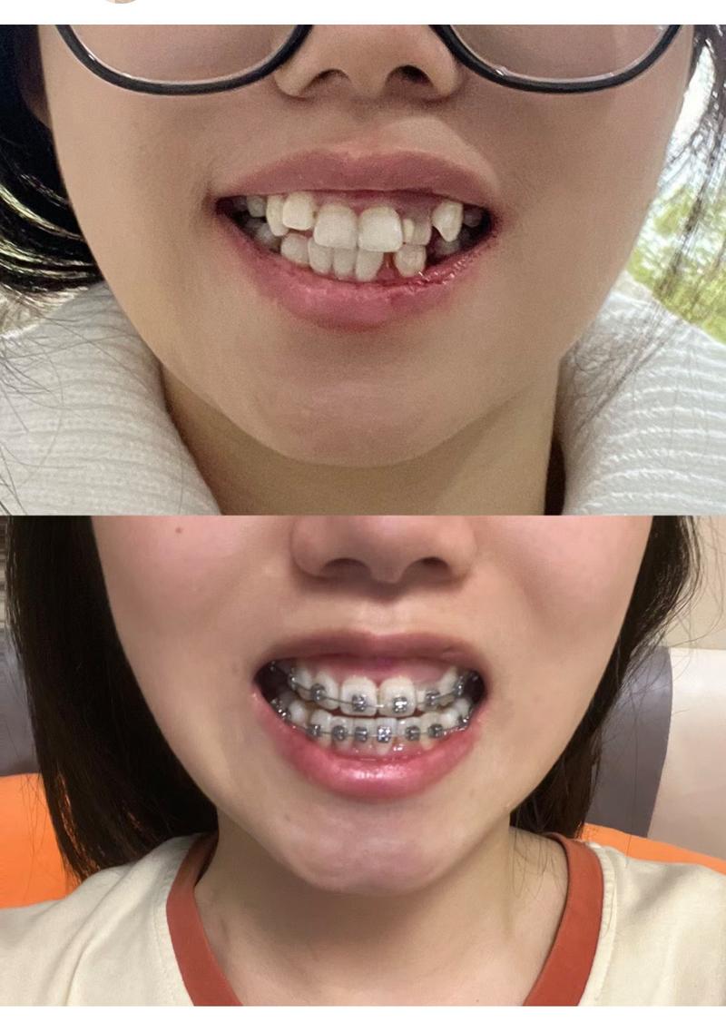 牙齿美白和矫正该先做哪个?-图2 牙齿美白和矫正该先做哪个?-图2