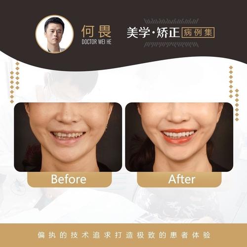 爱优牙牙齿矫正效果怎么样?适合哪些人做呢?-图1 爱优牙牙齿矫正效果怎么样?适合哪些人做呢?-图1