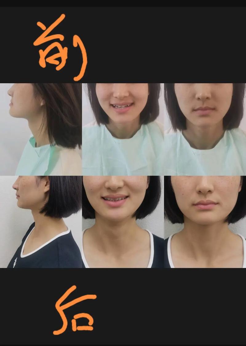 矫正牙齿侧面照-图2 矫正牙齿侧面照-图2