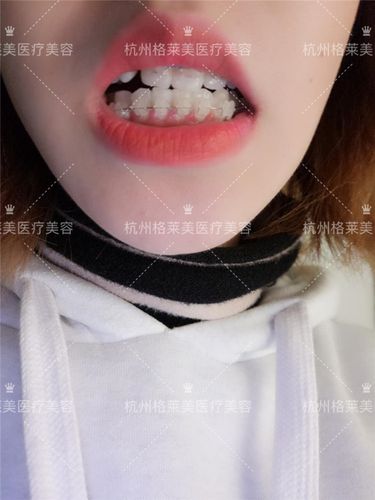 牙齿矫正格莱美-图2 牙齿矫正格莱美-图2