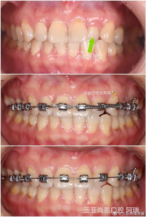 海南做牙齿矫正效果如何？价格贵不贵？哪家医院靠谱？-图1